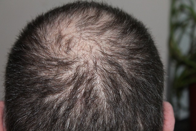 how to regrow bald hair naturally